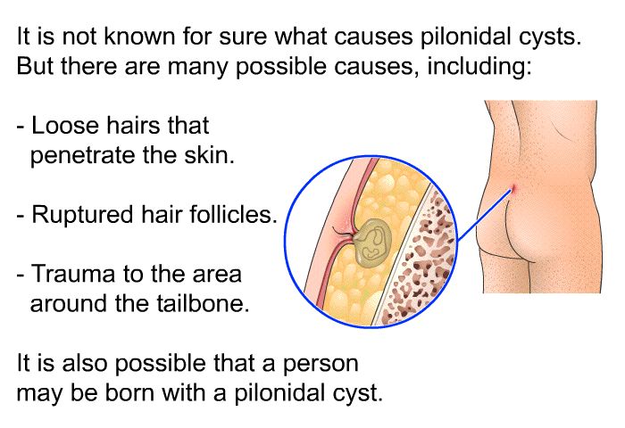 It is not known for sure what causes pilonidal cysts. But there are many possible causes, including:  Loose hairs that penetrate the skin. Ruptured hair follicles. Trauma to the area around the tailbone.  
 It is also possible that a person may be born with a pilonidal cyst.