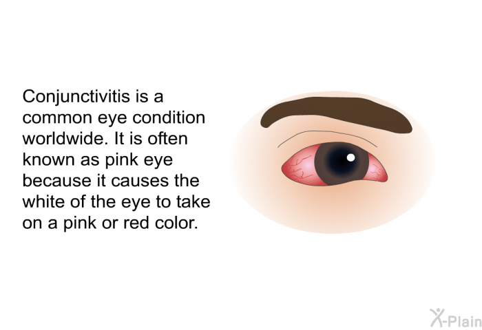 Conjunctivitis is a common eye condition worldwide. It is often known as pink eye because it causes the white of the eye to take on a pink or red color.