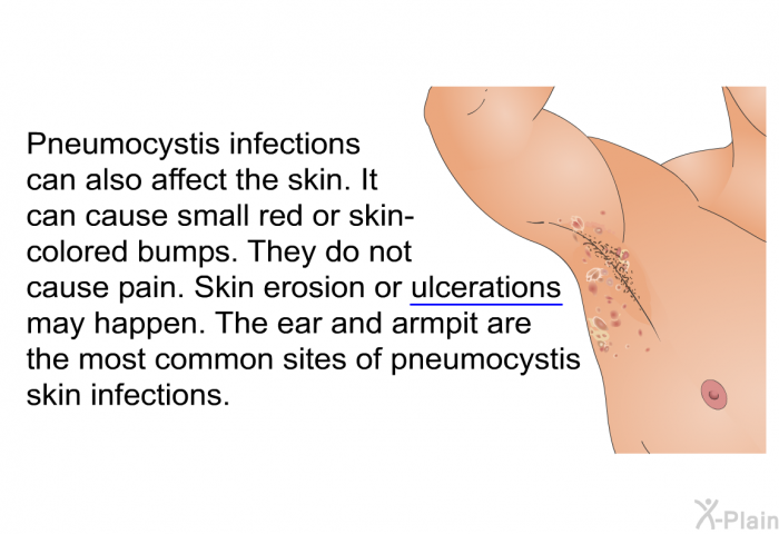 Pneumocystis infections can also affect the skin. It can cause small red or skin-colored bumps. They do not cause pain. Skin erosion or ulcerations may happen. The ear and armpit are the most common sites of pneumocystis skin infections.