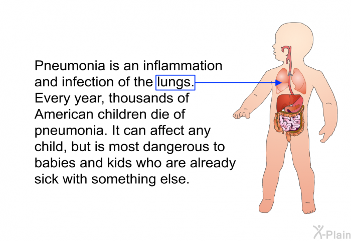 Pneumonia is an inflammation and infection of the lungs. Every year, thousands of American children die of pneumonia. It can affect any child, but is most dangerous to babies and kids who are already sick with something else.