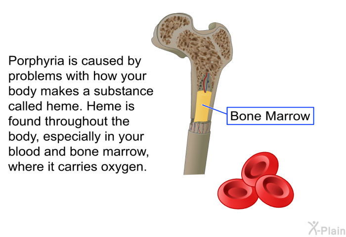 Porphyria is caused by problems with how your body makes a substance called heme. Heme is found throughout the body, especially in your blood and bone marrow, where it carries oxygen.