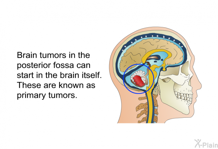 Brain tumors in the posterior fossa can start in the brain itself. These are known as primary tumors.