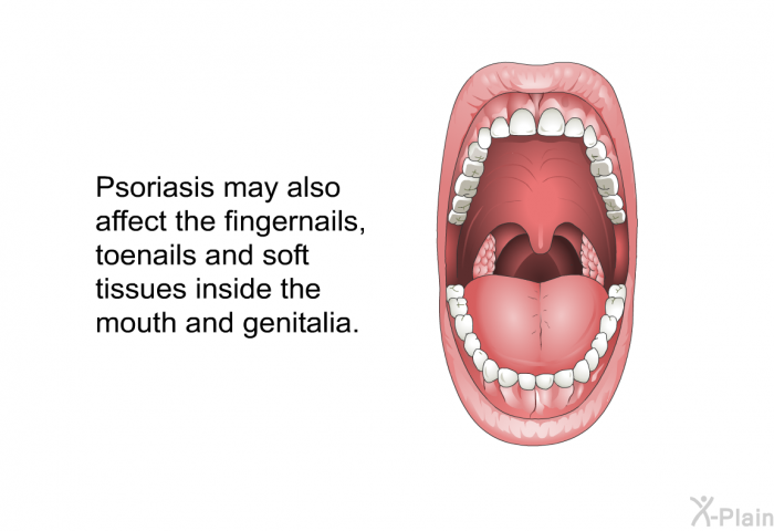 Psoriasis may also affect the fingernails, toenails and soft tissues inside the mouth and genitalia.