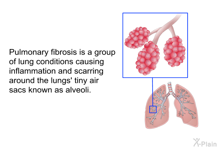 Pulmonary fibrosis is a group of lung conditions causing inflammation and scarring around the lungs' tiny air sacs known as alveoli.