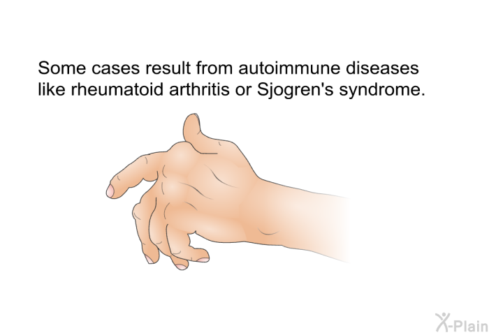 Some cases result from autoimmune diseases like rheumatoid arthritis or Sjogren's syndrome.