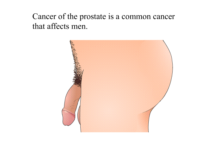 Cancer of the prostate is a common cancer that affects men.
