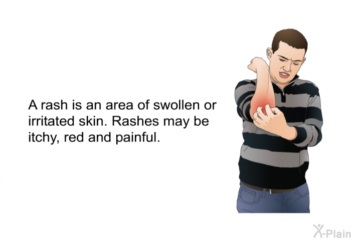 A rash is an area of swollen or irritated skin. Rashes may be itchy, red and painful.