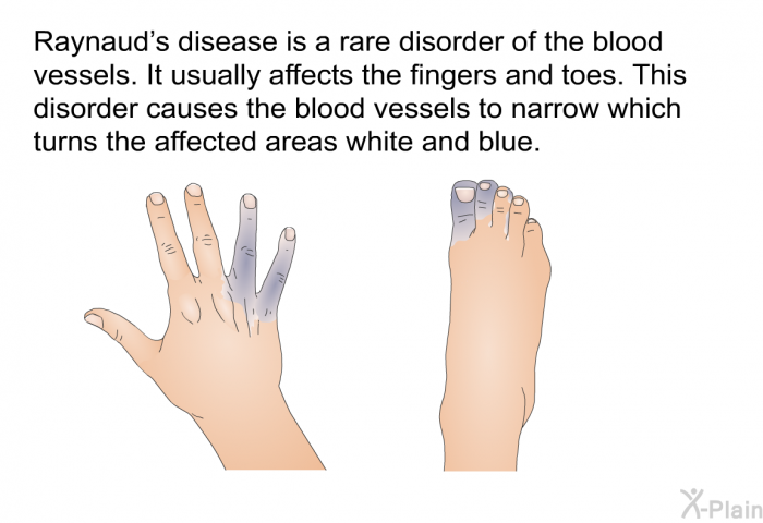 Raynaud's disease is a rare disorder of the blood vessels. It usually affects the fingers and toes. This disorder causes the blood vessels to narrow which turns the affected areas white and blue.