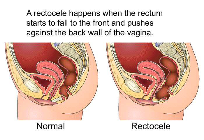 A rectocele happens when the rectum starts to fall to the front and pushes against the back wall of the vagina.