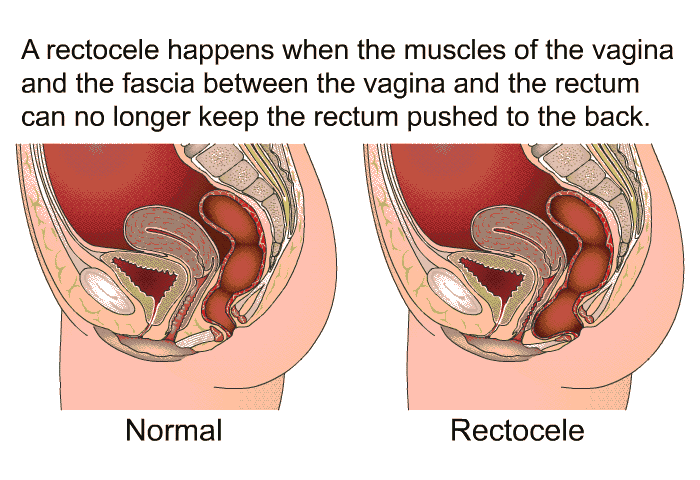 A rectocele happens when the muscles of the vagina and the fascia between the vagina and the rectum can no longer keep the rectum pushed to the back.