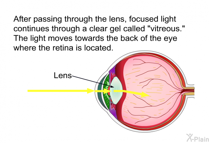 After passing through the lens, focused light continues through a clear gel called “vitreous.” The light moves towards the back of the eye where the retina is located.