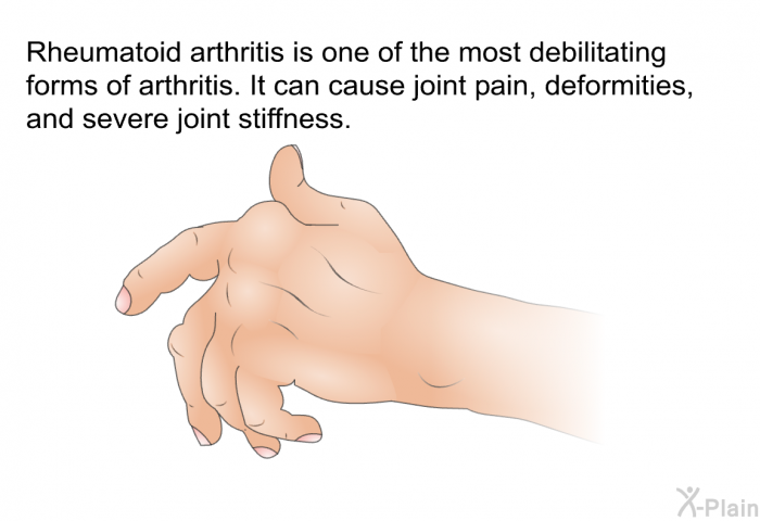 Rheumatoid arthritis is one of the most debilitating forms of arthritis. It can cause joint pain, deformities, and severe joint stiffness.