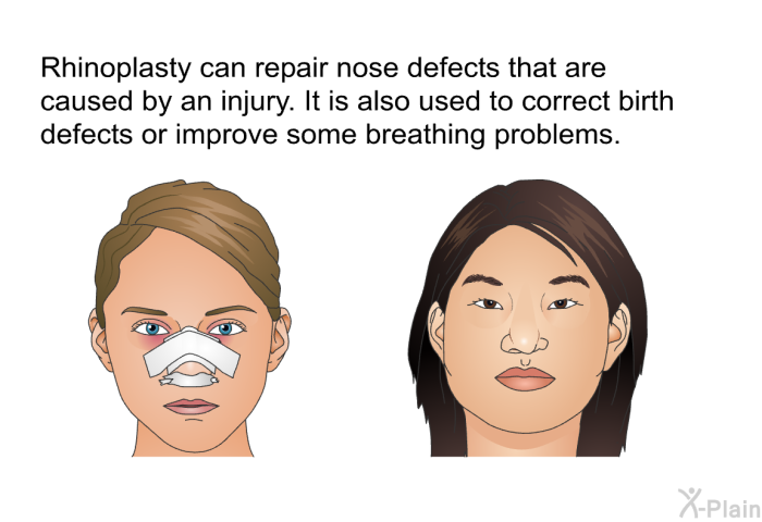 Rhinoplasty can repair nose defects that are caused by an injury. It is also used to correct birth defects or improve some breathing problems.
