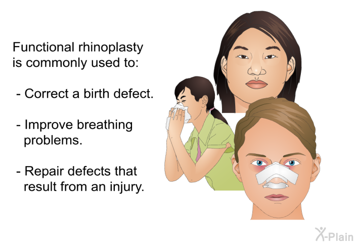 Functional rhinoplasty is commonly used to:  Correct a birth defect. Improve breathing problems. Repair defects that result from an injury.