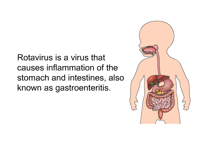 Rotavirus is a virus that causes inflammation of the stomach and intestines, also known as gastroenteritis.