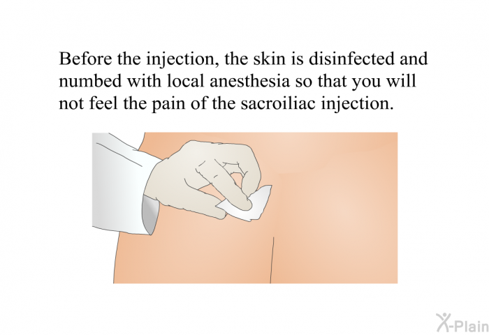 Before the injection, the skin is disinfected and numbed with local anesthesia so that you will not feel the pain of the sacroiliac injection.