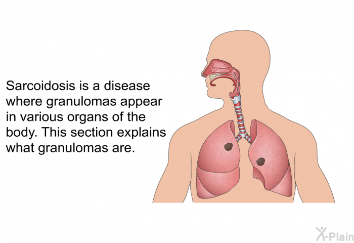 Sarcoidosis is a disease where <I>granulomas</I> appear in various organs of the body. This section explains what granulomas are.