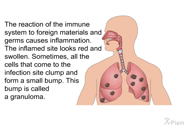 The reaction of the immune system to foreign materials and germs causes inflammation. The inflamed site looks red and swollen. Sometimes, all the cells that come to the infection site clump and form a small bump. This bump is called a granuloma.