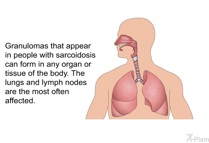 Granulomas that appear in people with sarcoidosis can form in any organ or tissue of the body. The lungs and lymph nodes are the most often affected.