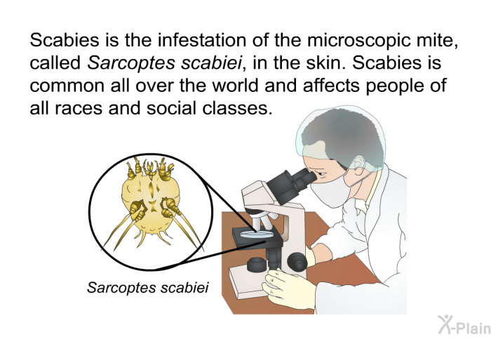 Scabies is the infestation of the microscopic mite, called Sarcoptes scabiei, in the skin. Scabies is common all over the world and affects people of all races and social classes.