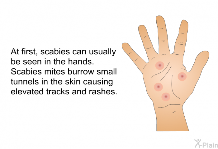 At first, scabies can usually be seen in the hands. Scabies mites burrow small tunnels in the skin causing elevated tracks and rashes.