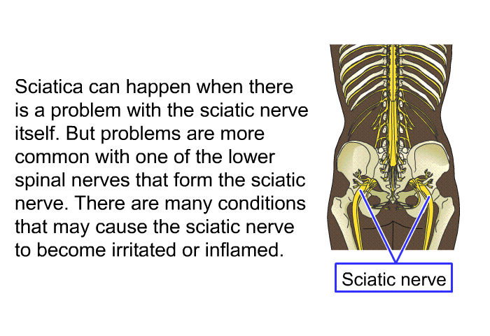 Sciatica can happen when there is a problem with the sciatic nerve itself. But problems are more common with one of the lower spinal nerves that form the sciatic nerve. There are many conditions that may cause the sciatic nerve to become irritated or inflamed.