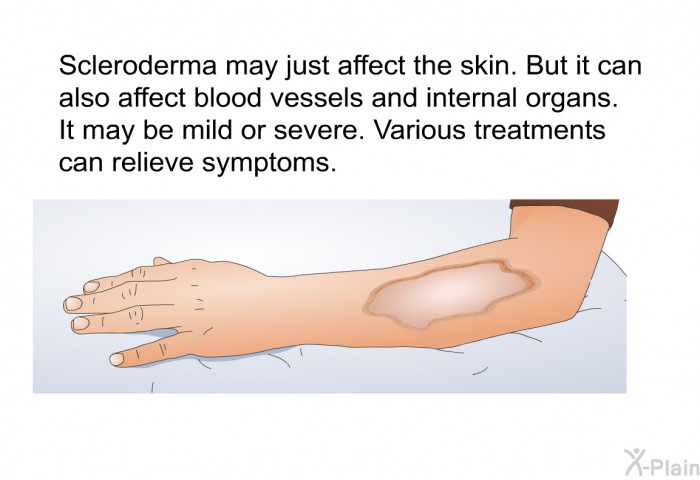 Scleroderma may just affect the skin. But it can also affect blood vessels and internal organs. It may be mild or severe. Various treatments can relieve symptoms.