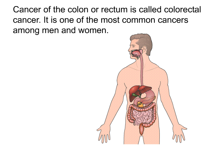 Cancer of the colon or rectum is called colorectal cancer. It is one of the most common cancers among men and women.