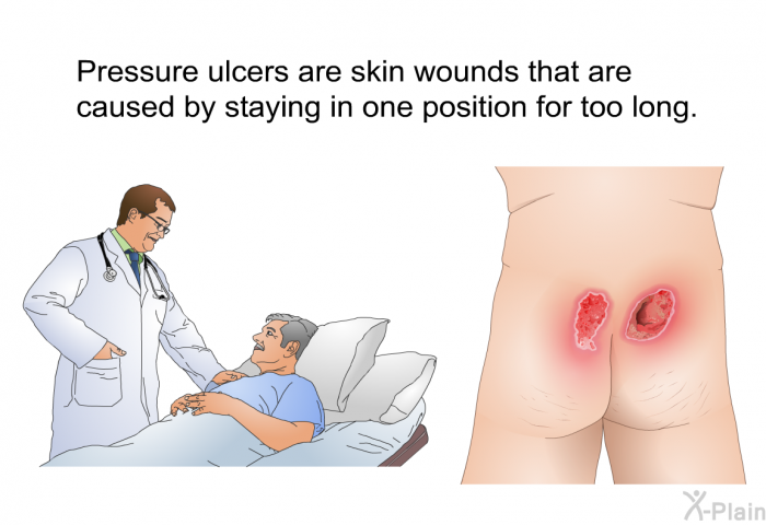 Pressure ulcers are skin wounds that are caused by staying in one position for too long.