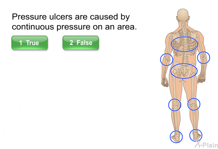 Pressure ulcers are caused by continuous pressure on an area.