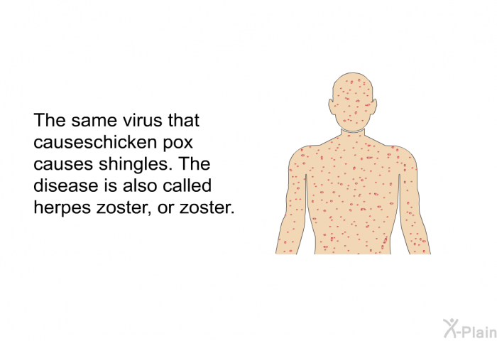 The same virus that causes chickenpox causes shingles. The disease is also called herpes zoster, or zoster.
