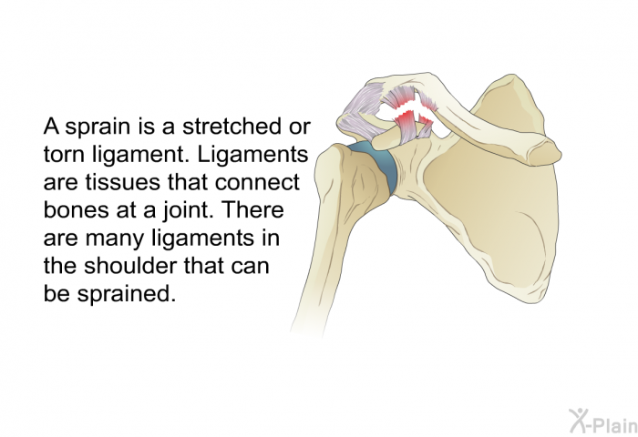 A sprain is a stretched or torn ligament. Ligaments are tissues that connect bones at a joint. There are many ligaments in the shoulder that can be sprained.