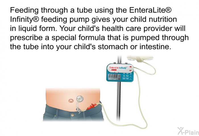 Feeding through a tube using the EnteraLite  Infinity  feeding pump gives your child nutrition in liquid form. Your child's health care provider will prescribe a special formula that is pumped through the tube into your child's stomach or intestine.