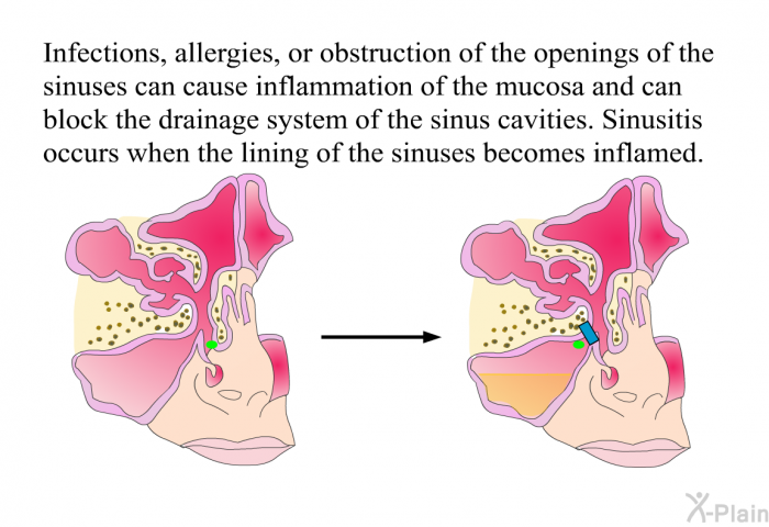 Infections, allergies, or obstruction of the openings of the sinuses can cause inflammation of the mucosa and can block the drainage system of the sinus cavities. Sinusitis occurs when the lining of the sinuses becomes inflamed.