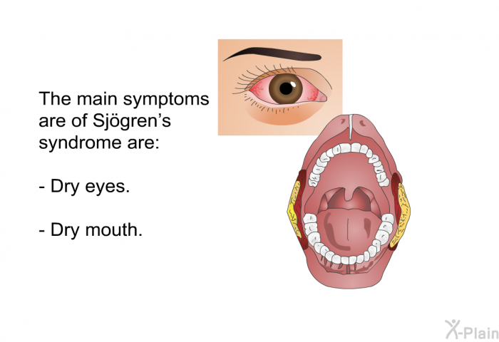 The main symptoms are of Sjögren's syndrome are:  Dry eyes. Dry mouth.