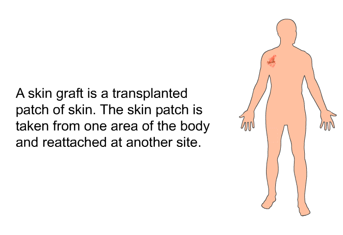 A skin graft is a transplanted patch of skin. The skin patch is taken from one area of the body and reattached at another site.