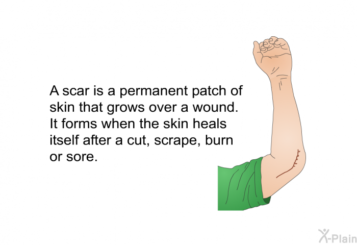 A scar is a permanent patch of skin that grows over a wound. It forms when the skin heals itself after a cut, scrape, burn or sore.