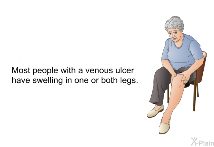 Most people with a venous ulcer have swelling in one or both legs.