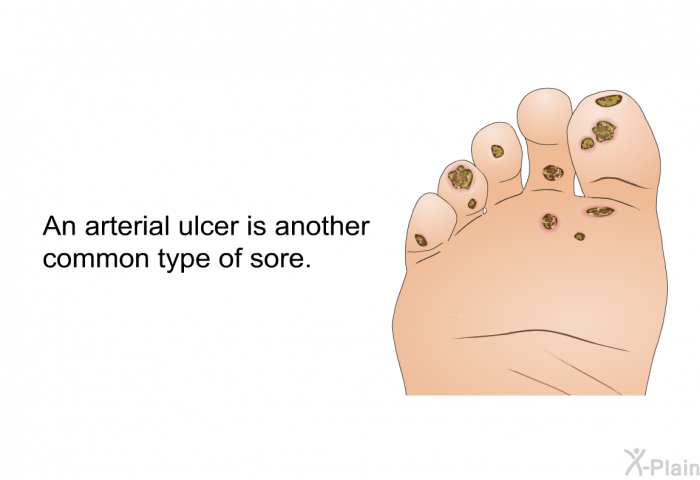 An arterial ulcer is another common type of sore.