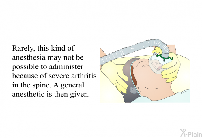 Rarely, this kind of anesthesia may not be possible to administer because of severe arthritis in the spine. A general anesthetic is then given.