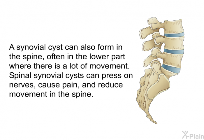 A synovial cyst can also form in the spine, often in the lower part where there is a lot of movement. Spinal synovial cysts can press on nerves, cause pain, and reduce movement in the spine.