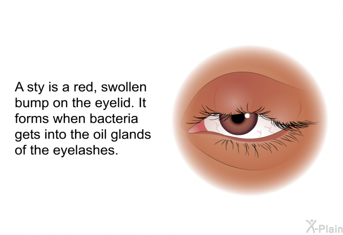 A sty is a red, swollen bump on the eyelid. It forms when bacteria gets into the oil glands of the eyelashes.