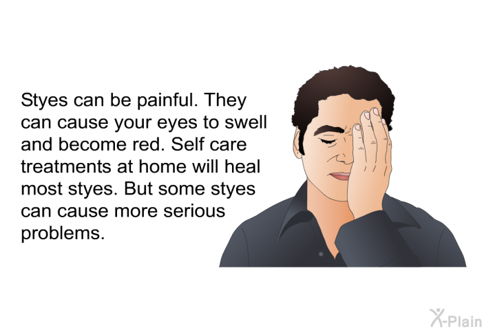 Styes can be painful. They can cause your eyes to swell and become red. Self care treatments at home will heal most styes. But some styes can cause more serious problems.