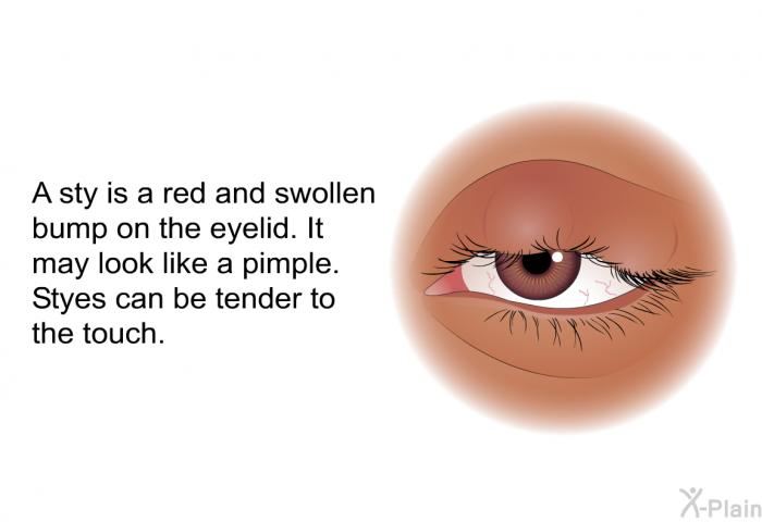A sty is a red and swollen bump on the eyelid. It may look like a pimple. Styes can be tender to the touch.