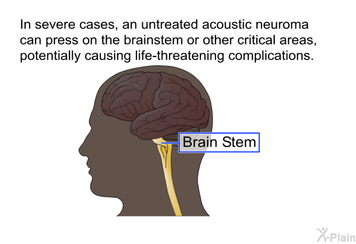 In severe cases, an untreated acoustic neuroma can press on the brainstem or other critical areas, potentially causing life-threatening complications.