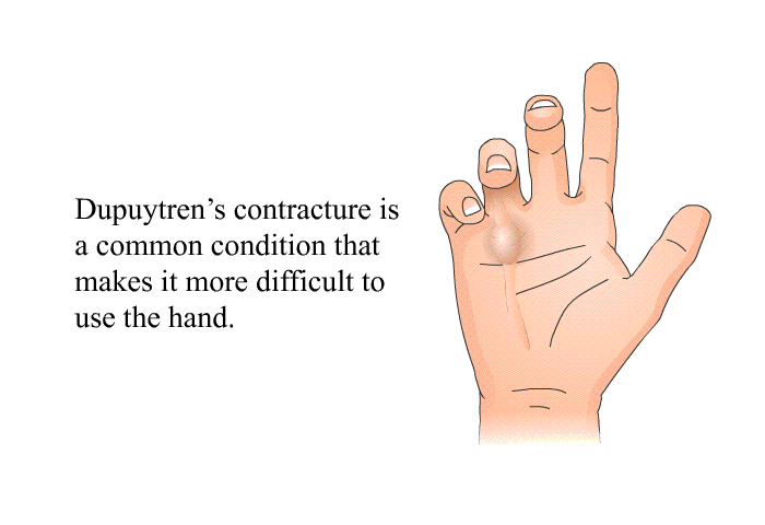 Dupuytren's contracture is a common condition that makes it more difficult to use the hand.