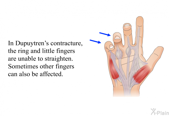 In Dupuytren's contracture, the ring and little fingers are unable to straighten. Sometimes other fingers can also be affected.
