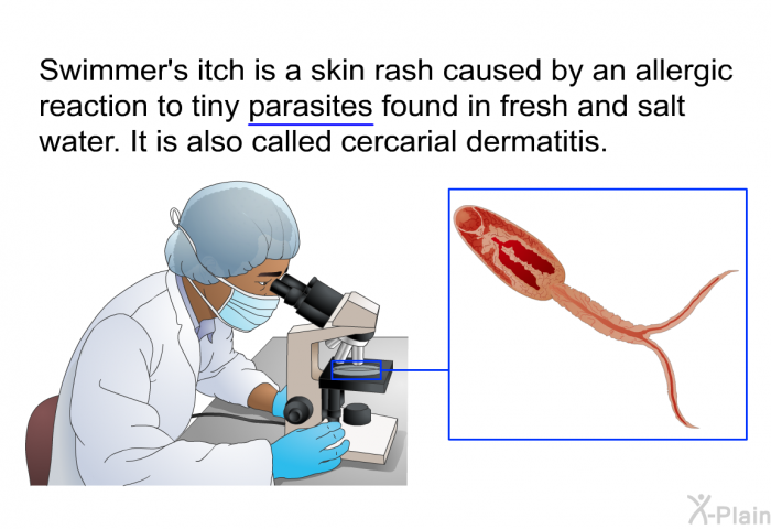 Swimmer's itch is a skin rash caused by an allergic reaction to tiny parasites found in fresh and salt water. It is also called cercarial dermatitis.