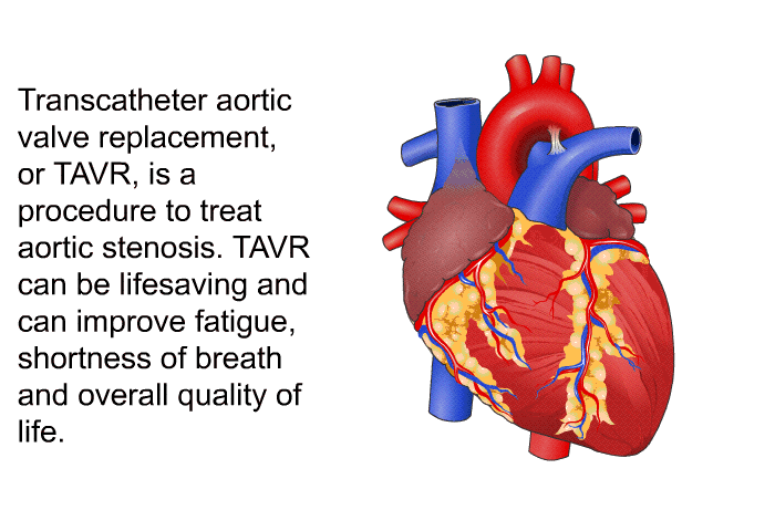Transcatheter aortic valve replacement, or TAVR, is a procedure to treat aortic stenosis. TAVR can be lifesaving and can improve fatigue, shortness of breath and overall quality of life.
