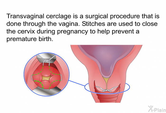 Transvaginal cerclage is a surgical procedure that is done through the vagina. Stitches are used to close the cervix during pregnancy to help prevent a premature birth.